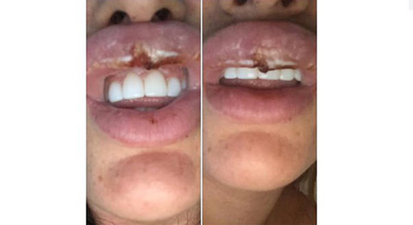 Cô gái suýt phải cắt bỏ môi vì theo đuổi trào lưu tiêm botox