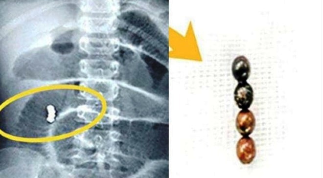 Kinh hãi gắp 4 viên bi nam châm kẹt ở ruột non bé gái 6 tuổi