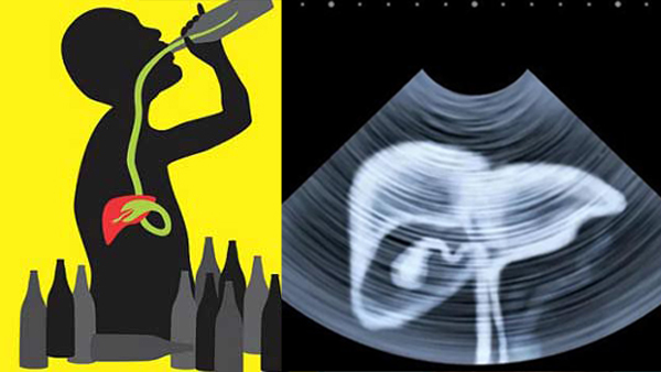 Chuyên gia chỉ điểm 5 kiểu người dễ ung thư gan, bạn có trong số đó?