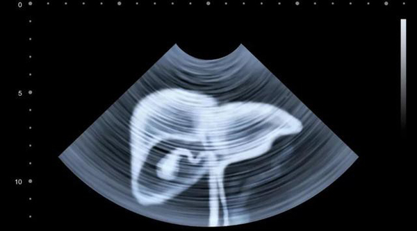 Chuyên gia chỉ điểm 5 kiểu người dễ ung thư gan, bạn có trong số đó?