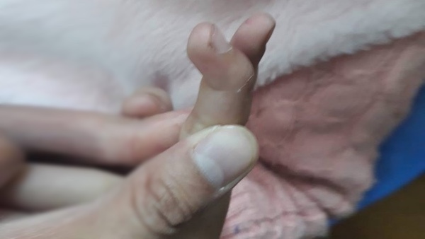 Tự chữa đứt tay tại nhà, bé 6 tuổi ở Hà Nội phải phẫu thuật nối gân