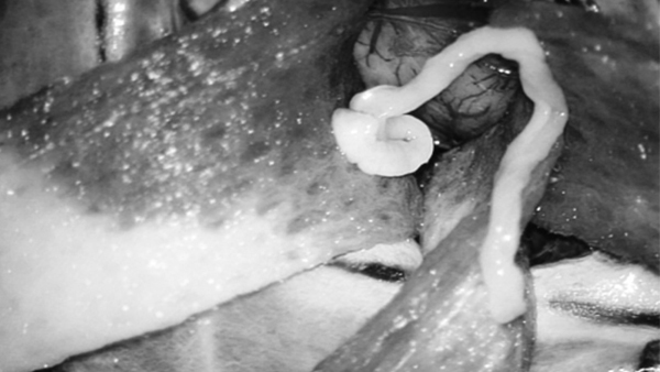 Người đàn ông co giật vì sán nhái dài 7 cm chui lên não