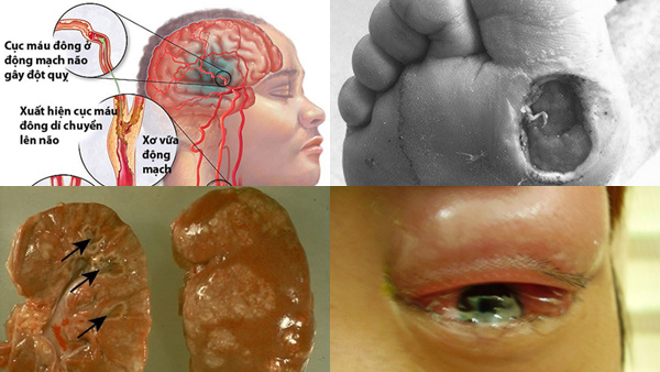 Biến chứng khủng khiếp của căn bệnh tiểu đường khiến NSND Anh Tú qua đời