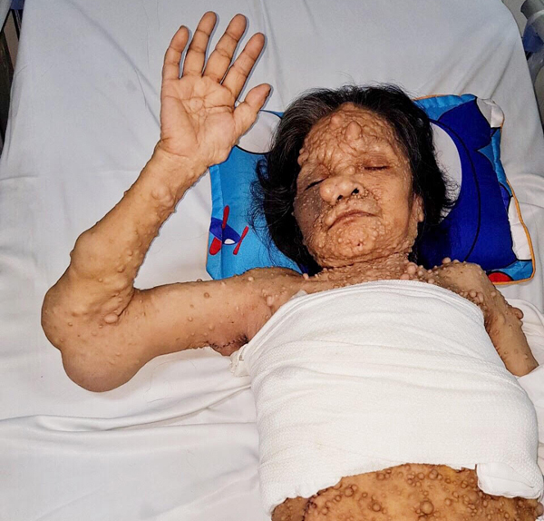 Người phụ nữ bị gọi là ‘quái nhân’, khắp người mọc u chi chít như sung