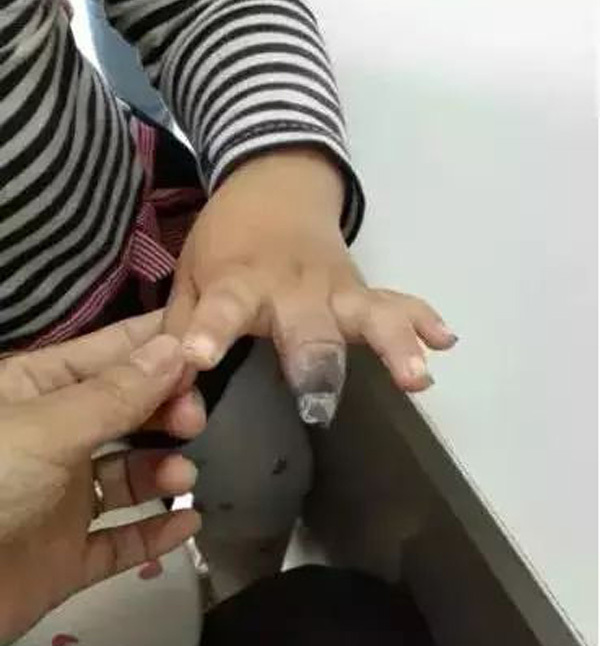 Dán urgo sai cách, bé gái 4 tuổi phải cắt bỏ 2 đốt ngón tay
