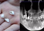 Cô gái 28 tuổi rụng răng, móm mém như cụ bà 80 vì thói quen xấu