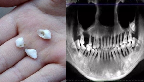Cô gái 28 tuổi rụng răng, móm mém như cụ bà 80 vì thói quen xấu