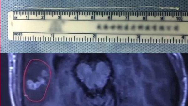 Sán dây 10cm vẫn ngoe nguẩy khi gắp khỏi não chàng trai trẻ