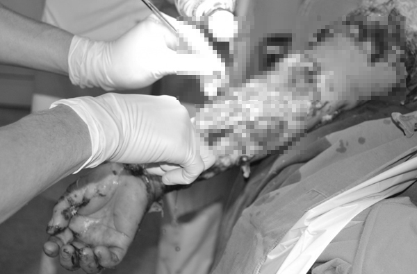 Bác sĩ rùng mình gỡ mủ trên cánh tay người phụ nữ