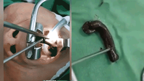 Video gắp đỉa từ cổ họng người phụ nữ Hà Giang lên báo thế giới