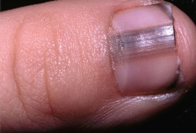 Những triệu chứng trên móng tay cảnh báo bệnh nguy hiểm