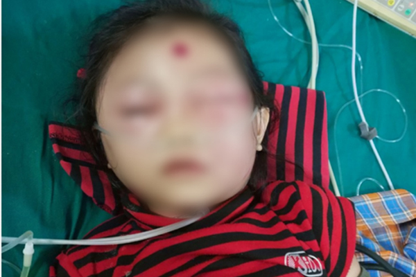 Bé gái 6 tuổi ở Phú Thọ suýt mất mạng chỉ vì nốt mụn nhỏ trên mặt