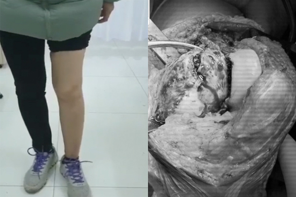 Nữ giáo viên 36 tuổi bị khối u ăn mục xương mà không biết