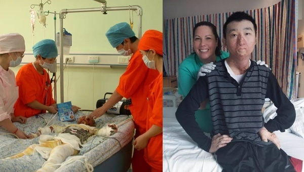 Cuộc sống của cậu bé 7 tuổi bị bỏng toàn thân 100% đầu tiên trên thế giới