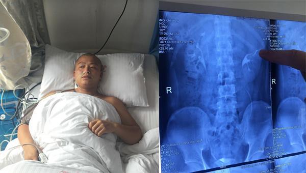 Nam thanh niên uống rượu thay nước lọc, đi khám phát hiện có 4 quả thận