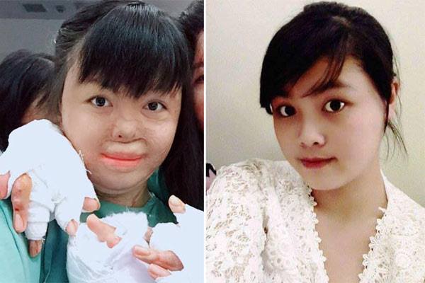 Người vợ xinh đẹp bị chồng đốt ngày mùng 2 Tết giờ ra sao?