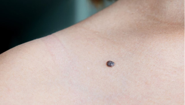 7 dấu hiệu cho thấy ung thư đang nhen nhóm trong cơ thể