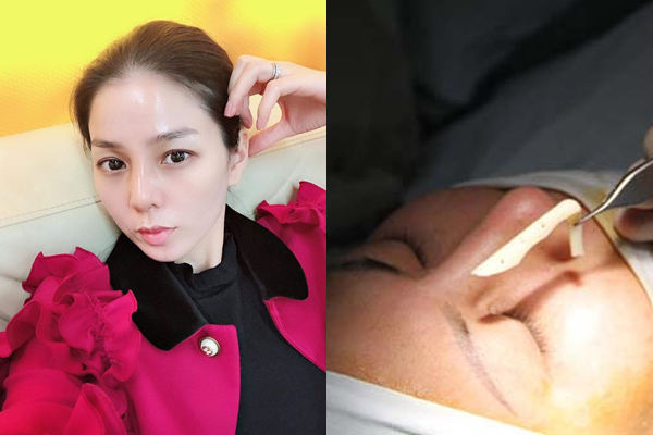 Sau vụ Lệ Quyên, nên nâng mũi bằng sụn giả hay sụn tự thân?