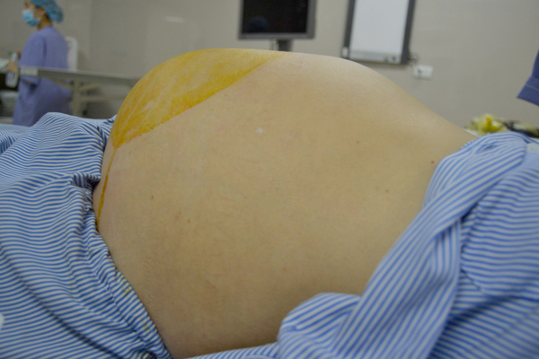 Người phụ nữ 61 tuổi bụng to như có bầu, bất ngờ khi nghe bác sĩ thông báo