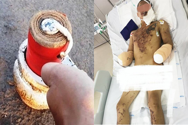 Nam thanh niên Hải Phòng bị pháo nổ bay 2 bàn tay