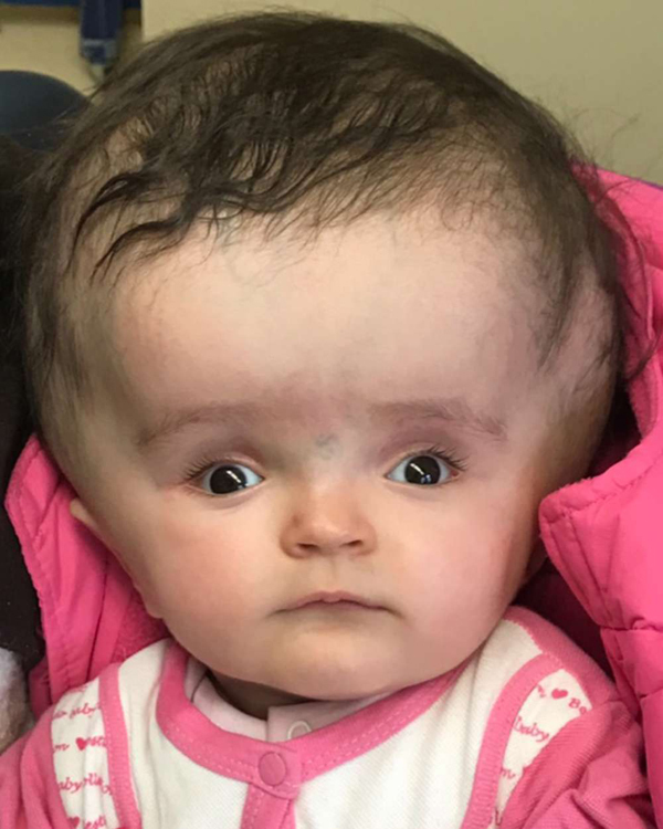 Bé gái 2 tuổi mắc bệnh não úng thủy được mổ gọt bớt đầu thành công 1