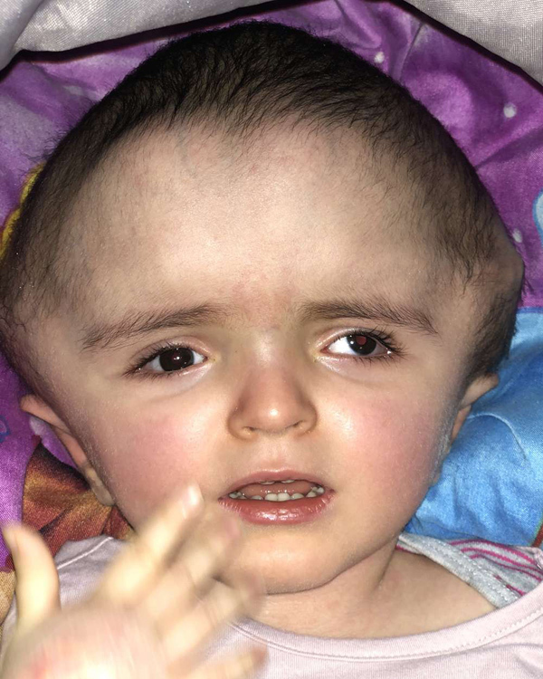 Bé gái 2 tuổi mắc bệnh não úng thủy được mổ gọt bớt đầu thành công 4
