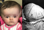 Bé gái 2 tuổi có đầu lớn hơn cơ thể được mổ gọt bớt đầu