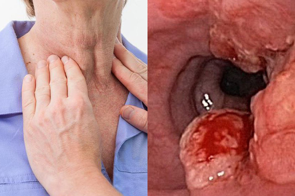 Nghiện 2 món triệu người thích, quý ông Vĩnh Phúc mắc ung thư thực quản