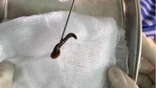 Con đỉa dài 6cm sống trong thanh quản của người đàn ông