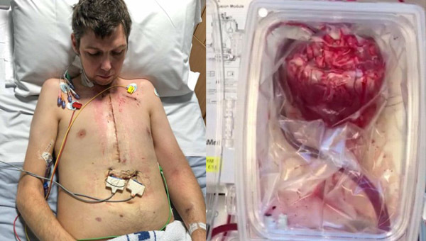 Người đàn ông sống sót nhờ trái tim tự đập trong hộp nhựa