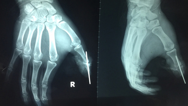 Chàng trai đứt lìa ngón tay do tai nạn từ 'trên trời rơi xuống'