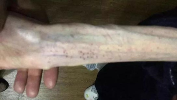 Cánh tay tong teo gây ám ảnh của cô gái trẻ sau 6 tháng giảm cân