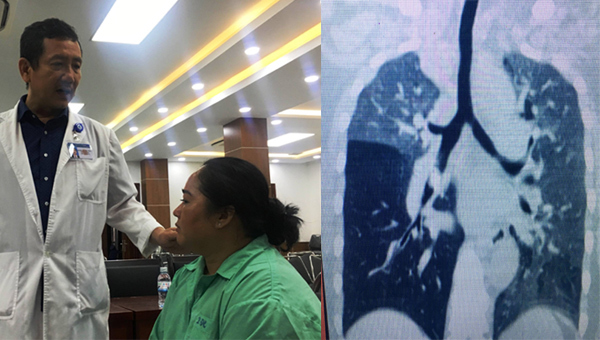 Chiếc xương vịt nằm trong đường thở suốt 10 tháng người phụ nữ Việt