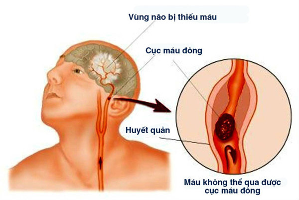 Thức khuya chơi điện tử, nam thanh niên 23 tuổi đột ngột tử vong