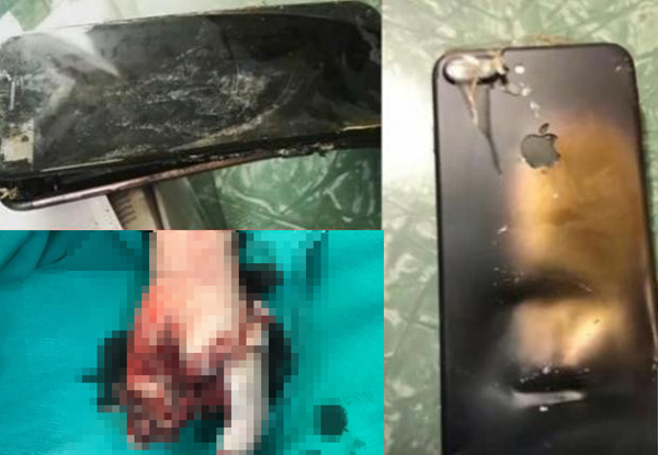 Dùng iPhone khi đang sạc, bé trai 13 tuổi bị nổ tung tay