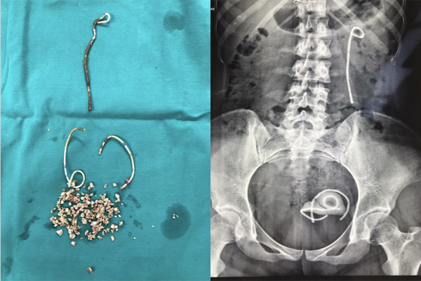 Cô gái Hà Nội bỏ quên stent 30cm trong bụng suốt 5 năm