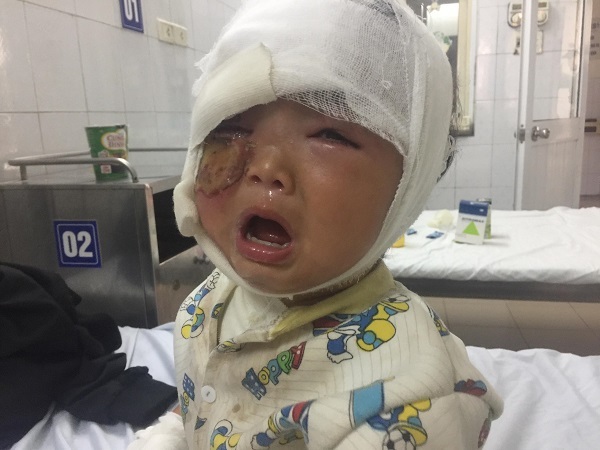 Ngã úp vào bếp lửa, bé gái có nguy cơ biến dạng khuôn mặt