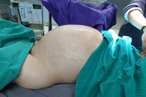 Nam thanh niên Vĩnh Phúc mắc ung thư mỡ, khối u 25kg