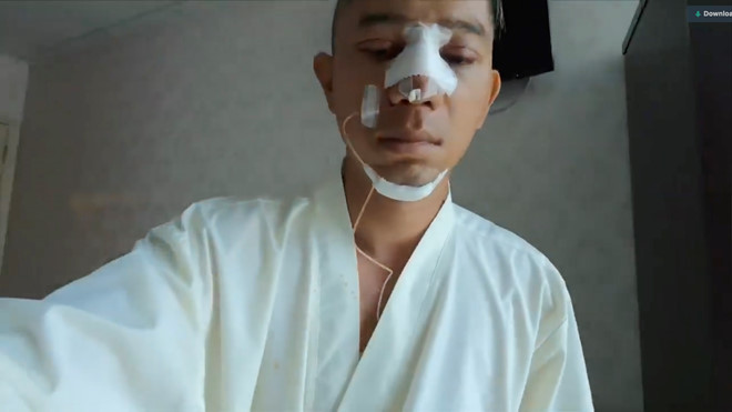 Lương Bằng Quang công khai phẫu thuật thẩm mỹ gương mặt sau 1 ngày
