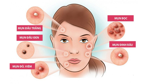 Trị mụn tại nhà đơn giản, hiệu quả chỉ mất vài phút mỗi ngày