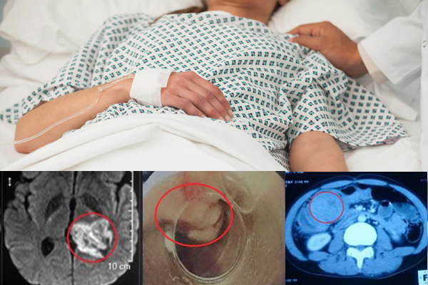 Nam sinh 18 tuổi ở Nghệ An mắc 3 bệnh ung thư cùng lúc