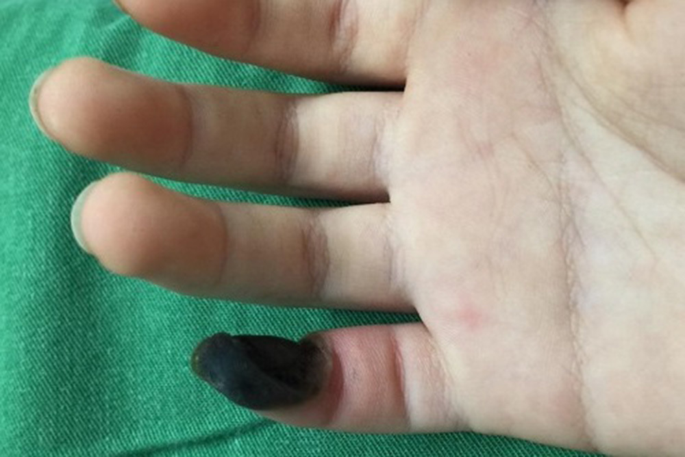Bé 6 tuổi hoại tử ngón tay vì tự chữa mụn cóc