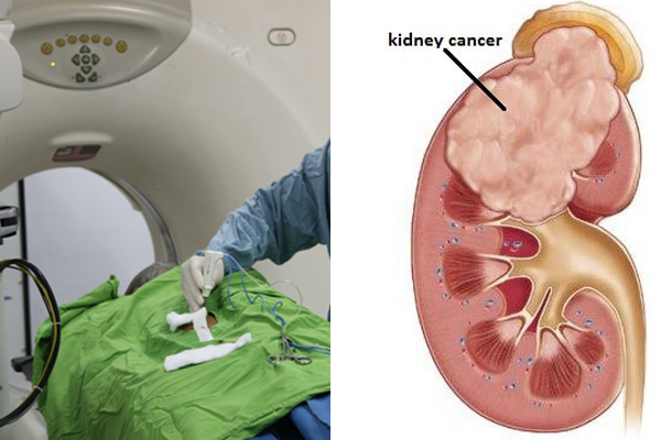 Đi tiểu ra máu, người đàn ông Phú Thọ phát hiện ung thư thận di căn