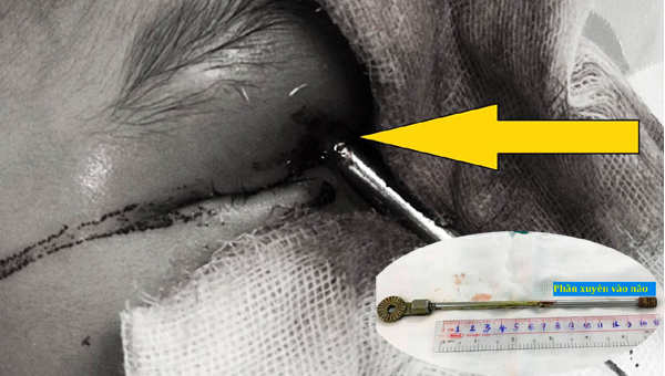 Kì diệu: Cứu sống bé trai 5 tuổi bị thanh sắt đâm xuyên hốc mắt vào não