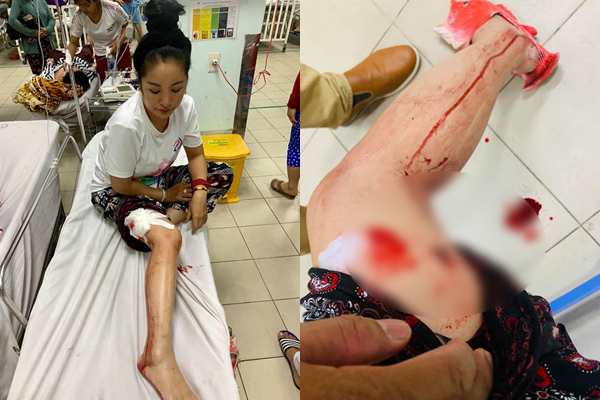 Nghệ sĩ Thúy Nga gặp tai nạn phải khâu gần 10 mũi ở chân