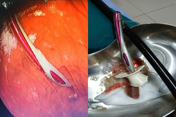 Bàn chải đánh răng chui tọt vào bụng cô gái Thái Nguyên