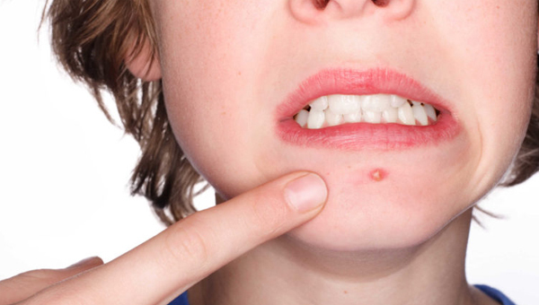 5 loại thực phẩm khiến tình trạng mụn trứng cá thêm nặng