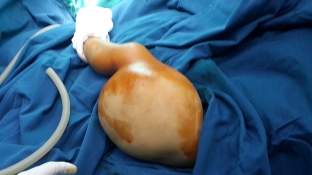 Bé trai Thanh Hoá mọc khối u khổng lồ ở đùi do lỗi của mẹ khi mang bầu