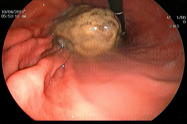 Ai ăn bột nghệ hàng ngày, cần biết thông tin này để không phải nhập viện