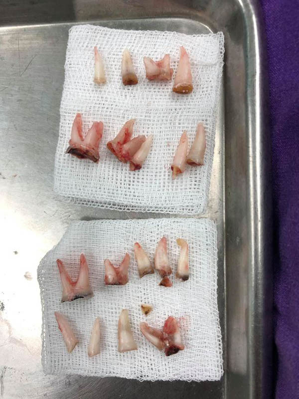 Cậu bé 4 tuổi bị nhổ 18 chiếc răng sâu vì sự thiếu sót của cha mẹ